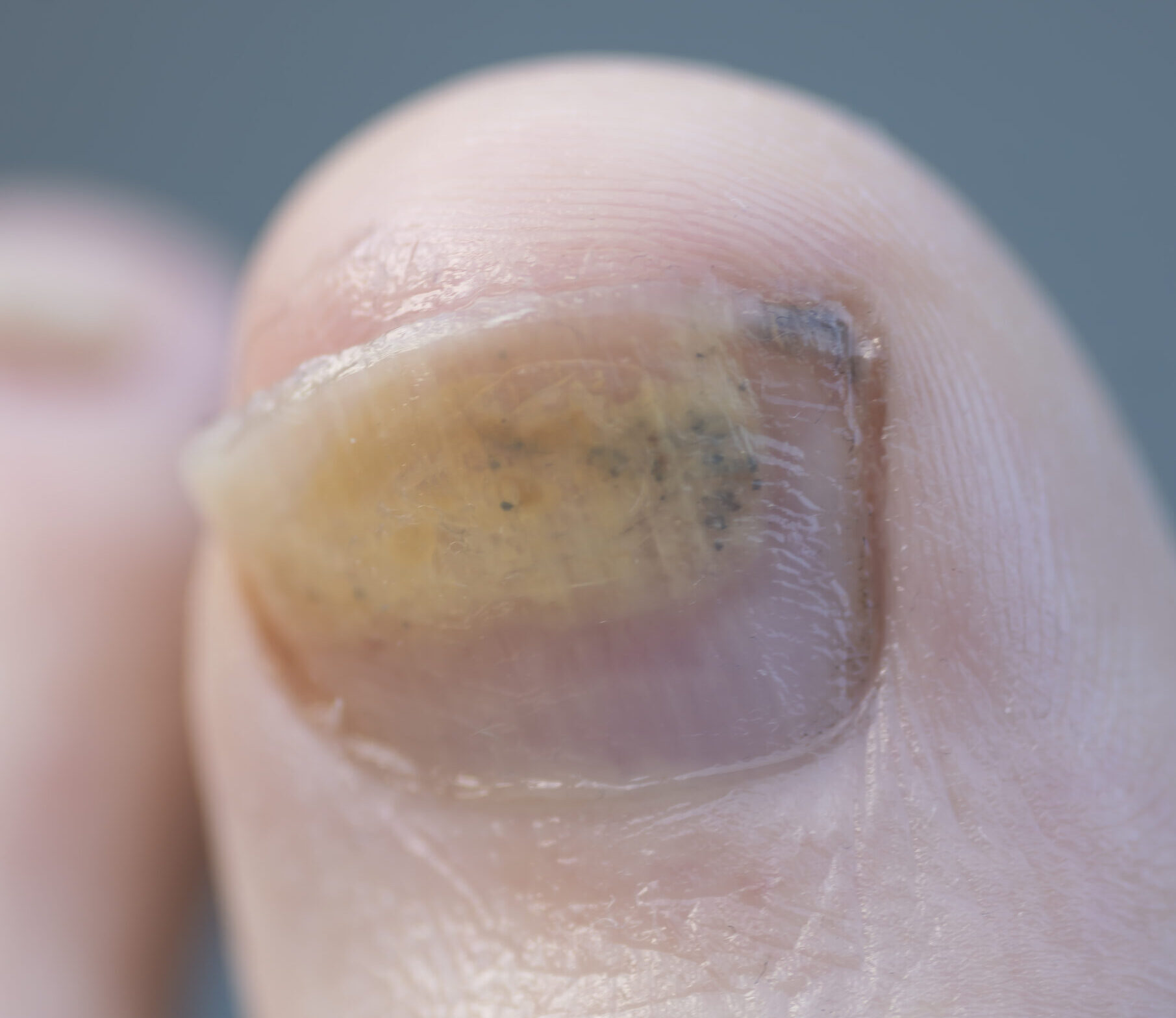 Big Toe With Fungal Growth On The Toenail Unique Soles Mobile Foot 